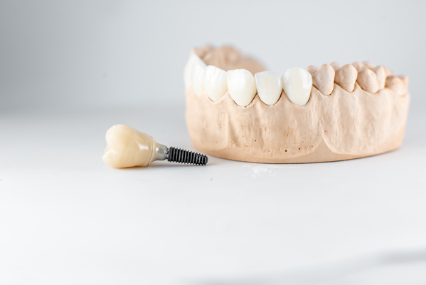 Reasons To Choose Implants For Tooth Restoration